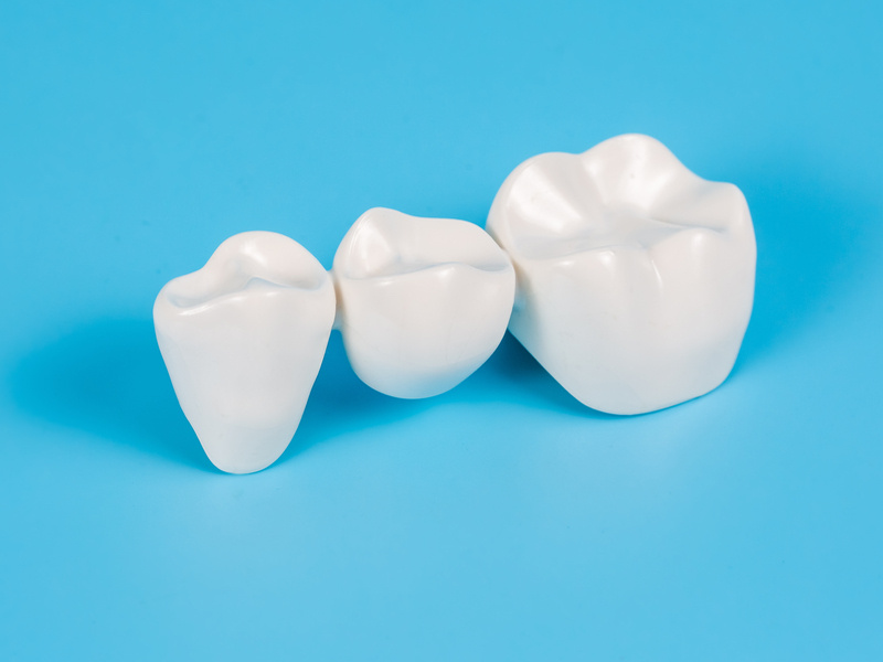 Πότε χρειάζεται η γέφυρα δοντιών;