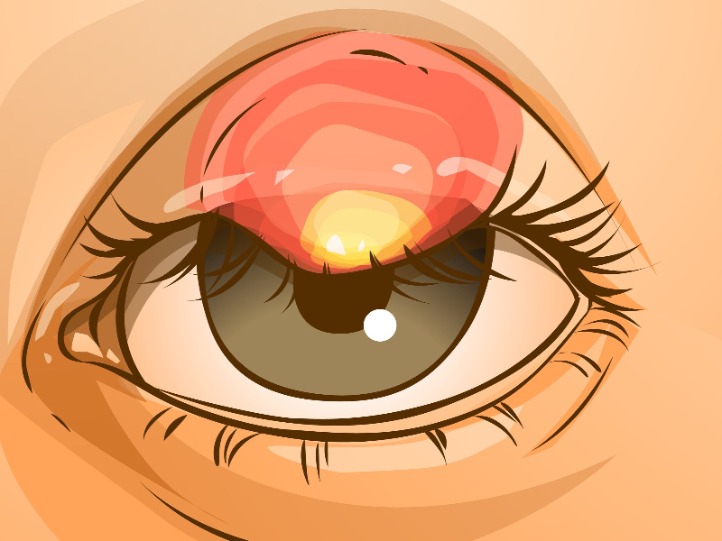 Χαλάζιο στο μάτι: Τι είναι, αίτια και θεραπεία