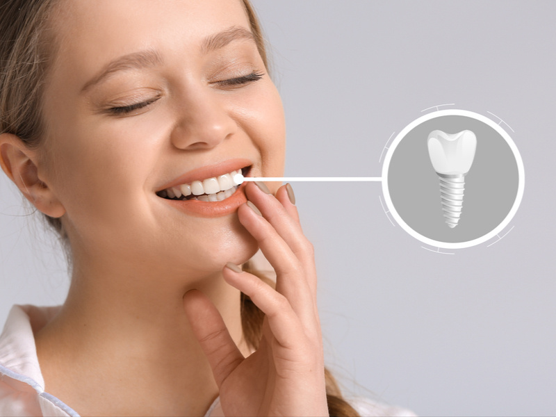 Eμφυτεύματα δοντιών: Τι είναι, διαδικασία και τιμές